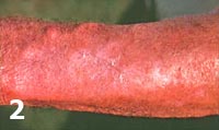 Loxosceles reclusa